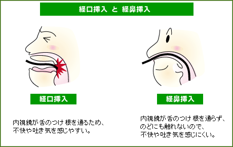 経口挿入と経鼻挿入